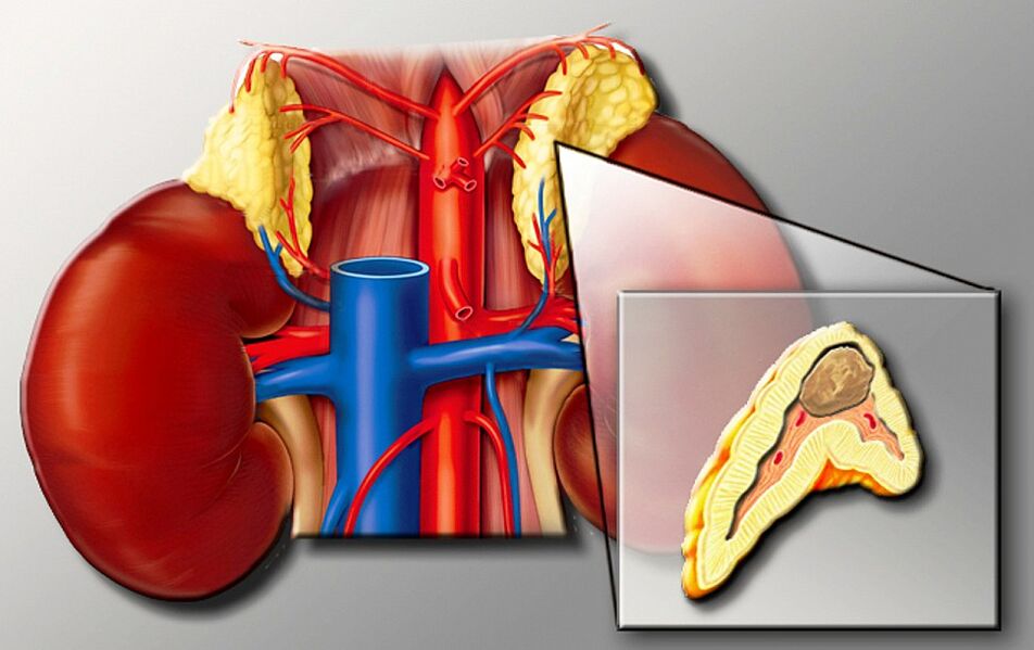 Hypertension for hypertension